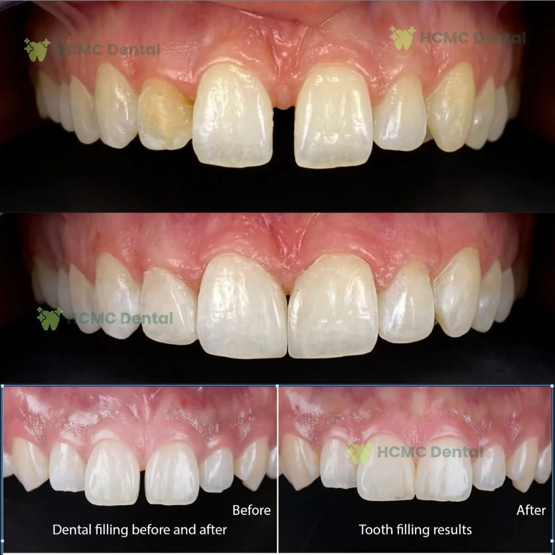 Anterior Chipped Tooth Cosmetic Restoration Before and After - Dr. Cuong Anterior Chipped Tooth Cosmetic Restoration Dr Cuong Saigon