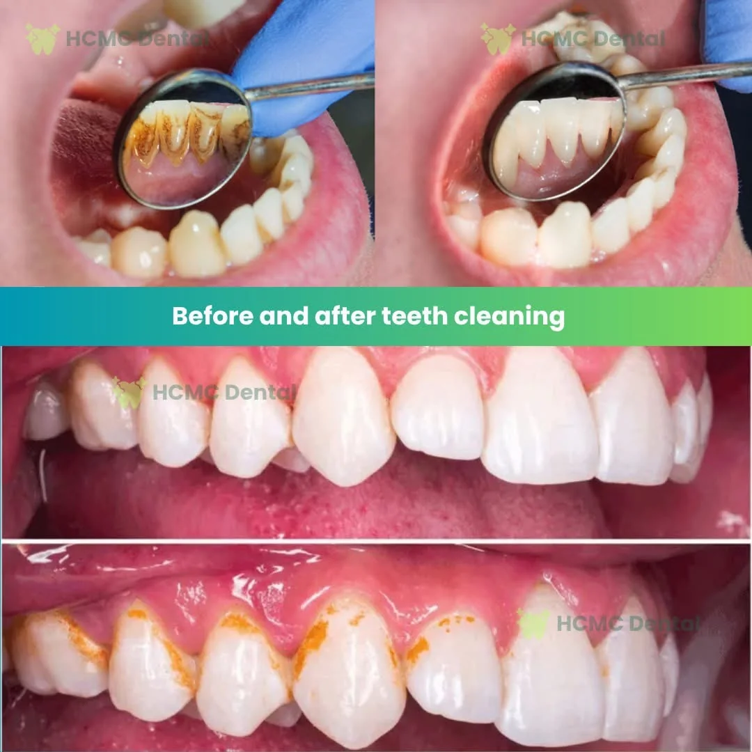 Deep Ultrasonic Tartar Scaling & Periodontal Cleaning - Dr. Cuong Ultrasonic Tartar Scaling and Deep Cleaning Before After HCMC Dental