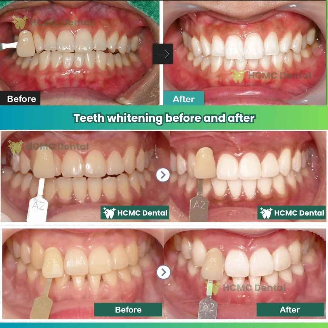 Zoom Laser Whitening with VITA Shade Guide Evaluation - Dr. Cuong In Office Zoom Laser Whitening Shade Guide Results Dr Cuong Saigon