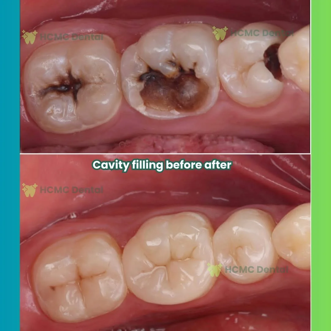 Molar Tooth Decay Aesthetic Composite Filling - Dr. Cuong Molar Tooth Decay Aesthetic Composite Filling Dr Cuong HCMC