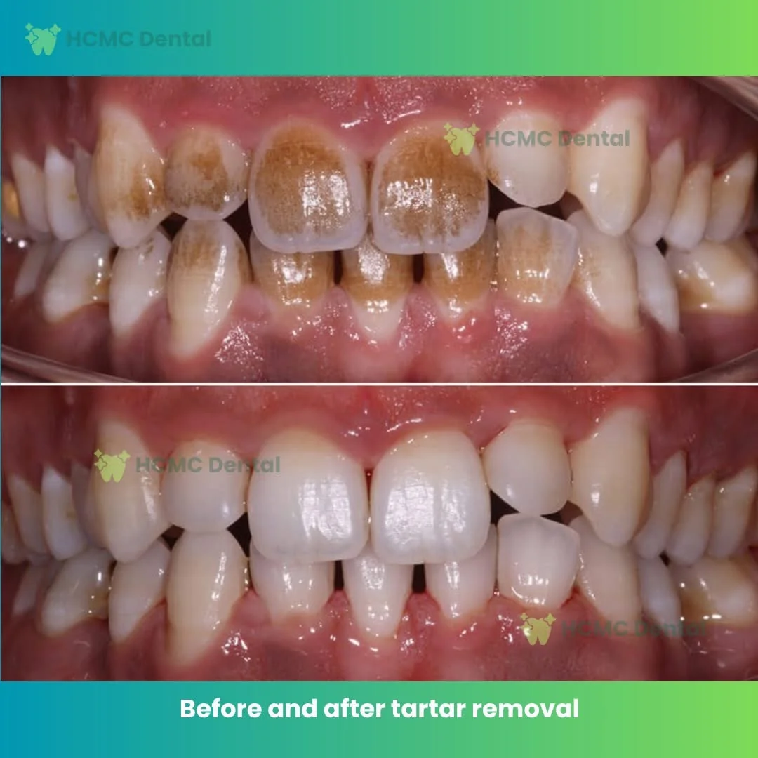 Swiss Airflow Plaque and Tobacco Stain Polishing - Dr. Cuong Stain Plaque Removal Airflow Polishing Saigon Vietnam